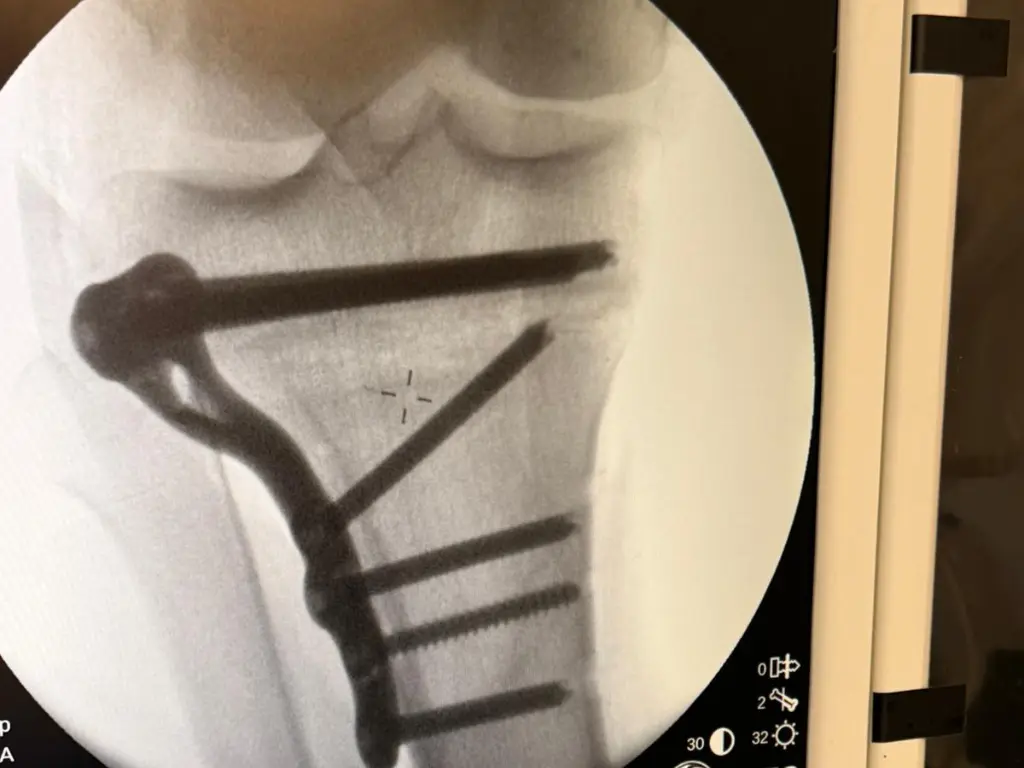 Control radiológico intraoperatorio durante la cirugía de rodilla
