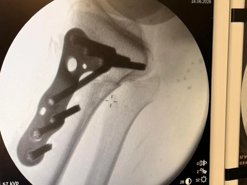 Control radiológico intraoperatorio tras osteotomía tibial por inestabilidad femoropatelar